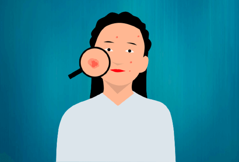 Trucos sencillos para combatir el acné avalados por la ciencia